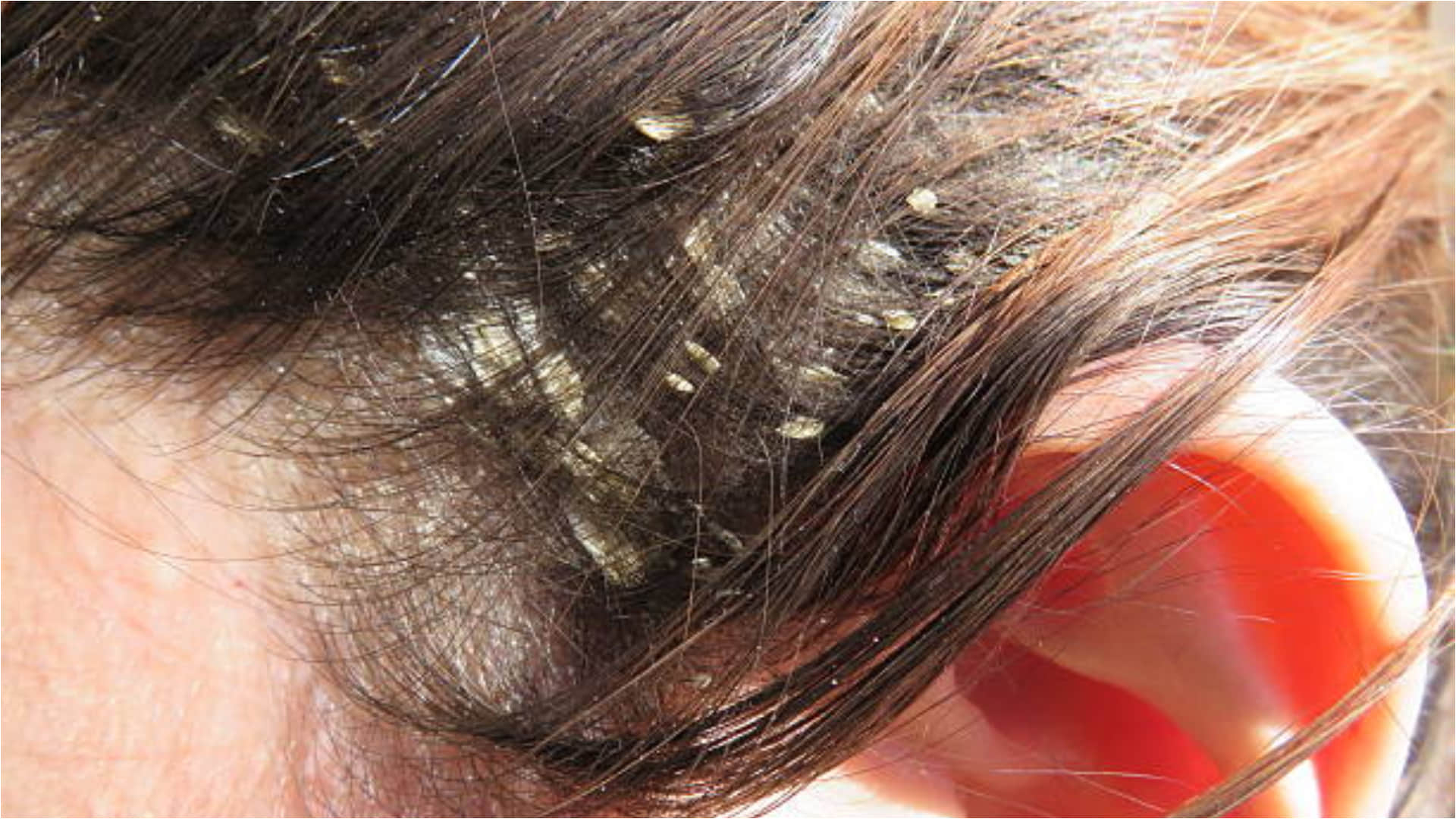 Dandruff Home Remedies How To Use Lemon To Get Rid Of Dandruff In Winters