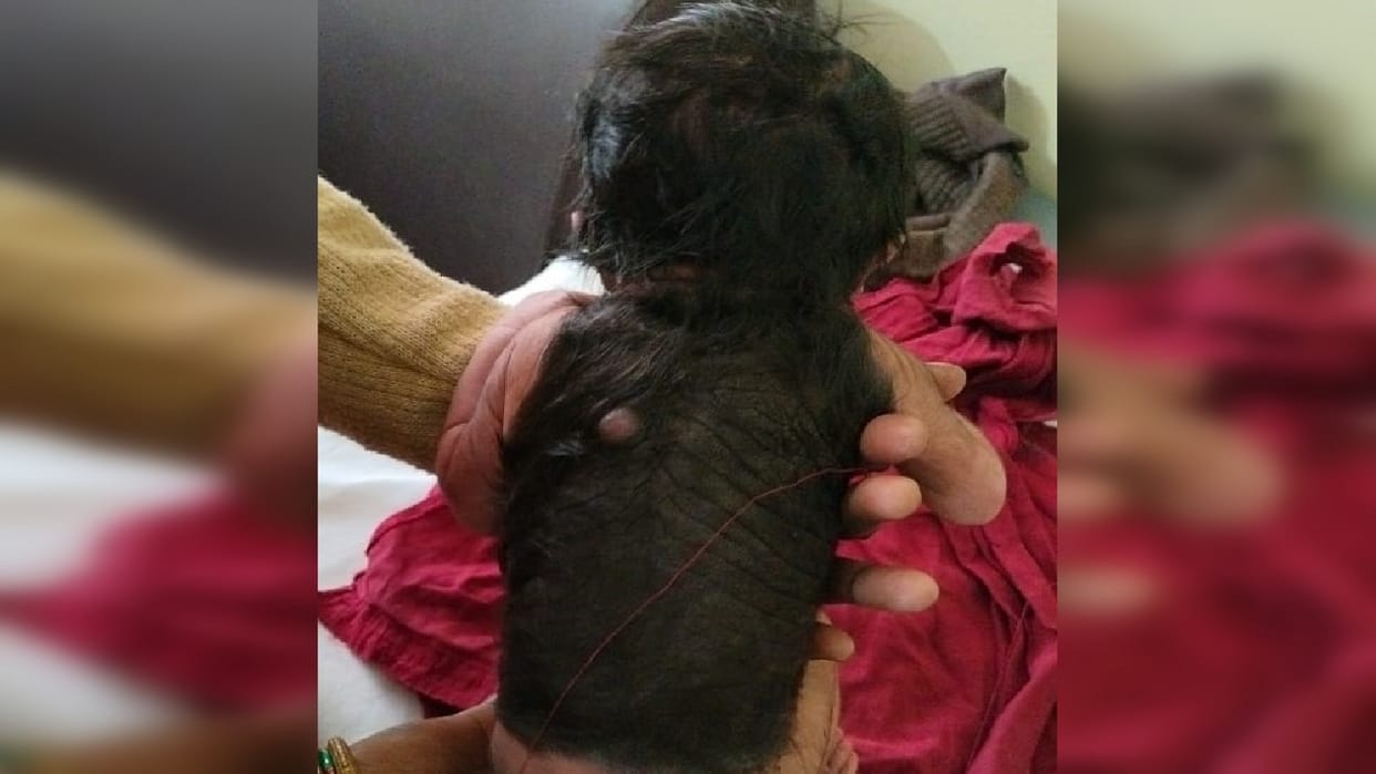 Woman gave birth to a strange child in Hardoi hair on 70 percent of the body