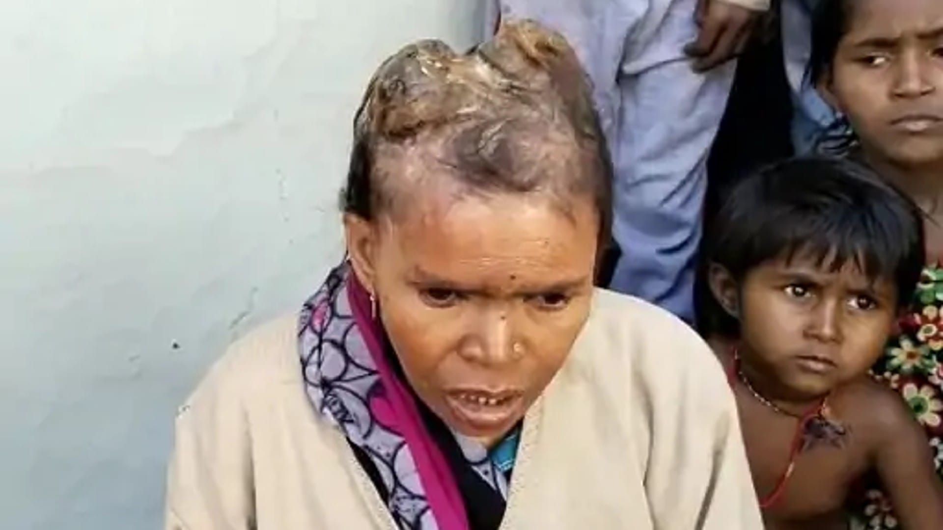 महिला को अजीब बीमारी हो गई है, सिर पर सींग जैसे आकार बन रहा है।