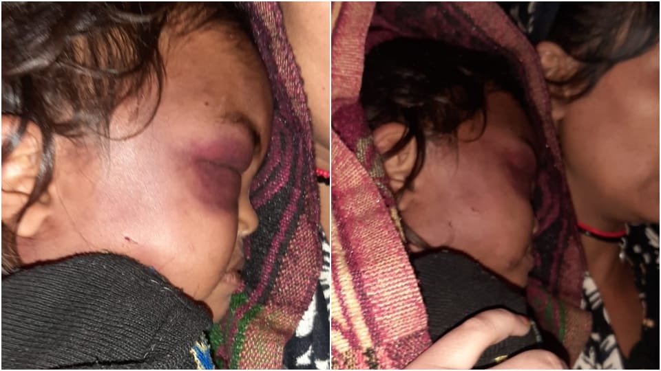 Step Father Beat up one year old daughter  arrested in Shri Ganganagar