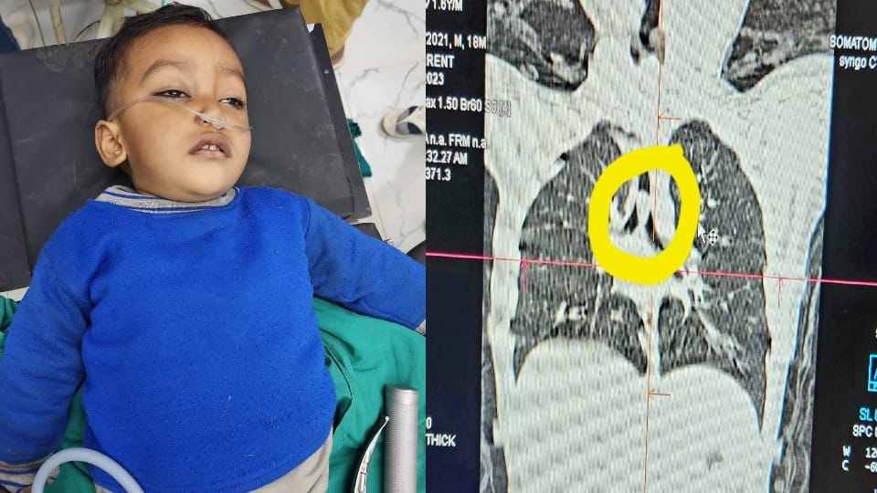 Peanut stuck in the child lungs doctors saved his life by operation in firozabad