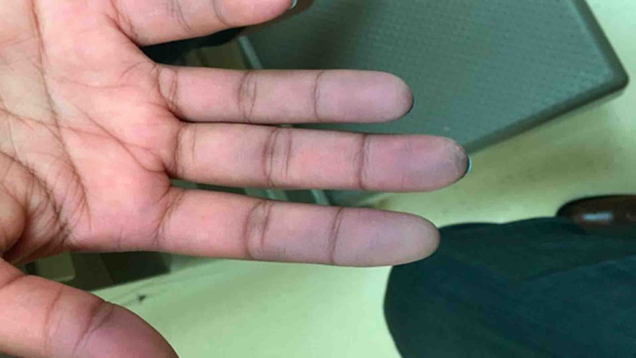 Kanpur: Fingers start turning black, gangrene patients increased