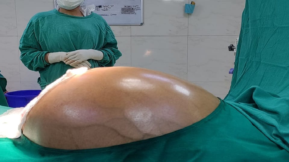 Doctors remove 22 kg tumor from woman's stomach after surgery in Delhi