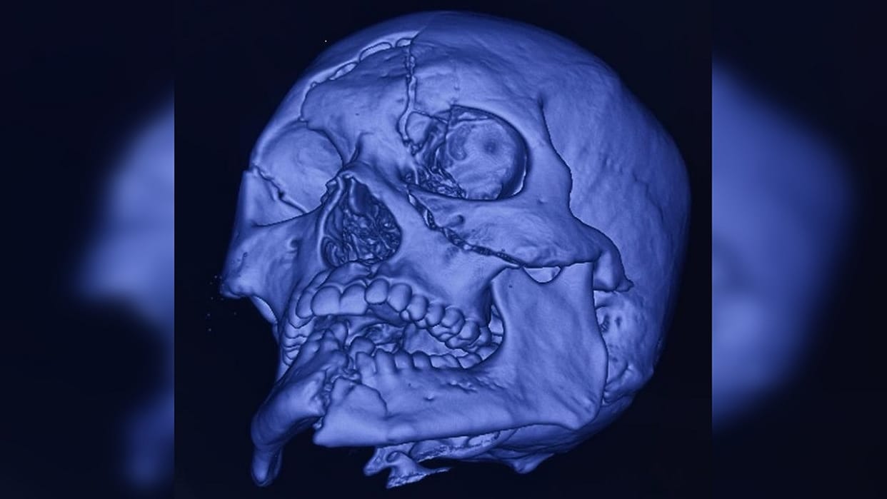 16 fractures on face broken skull and tongue divided into two pieces in accident