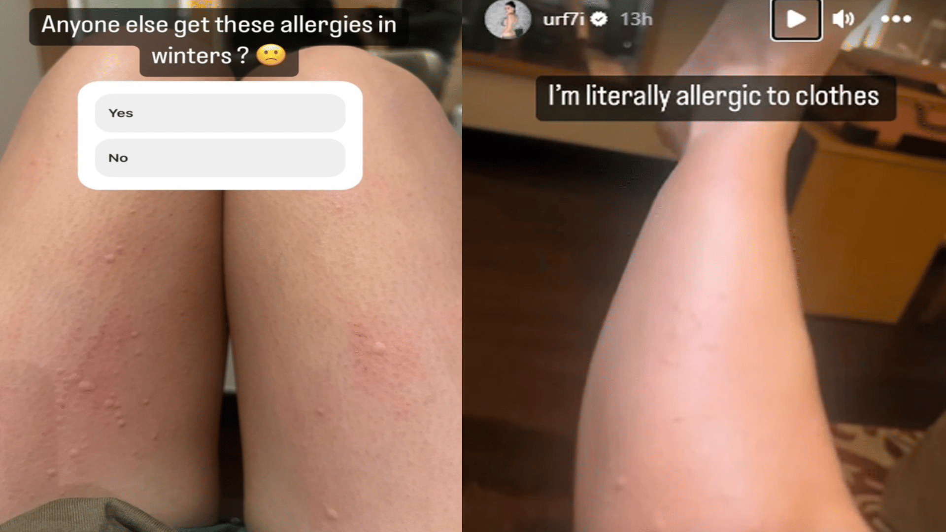 Urfi javed allergic to wear full winter clothes actress shares pics of rashes on her body photos goes viral