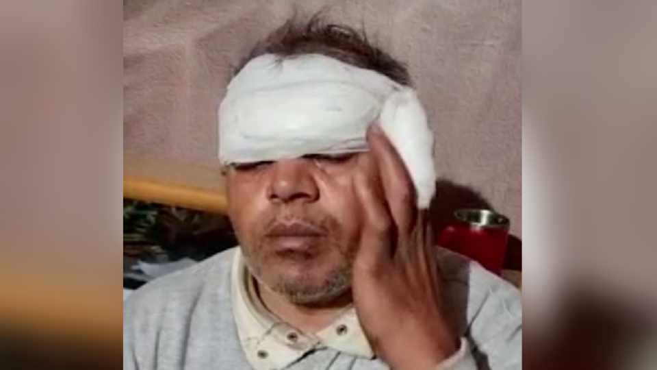 Person injured by Chinese manjha in Halwara of Punjab