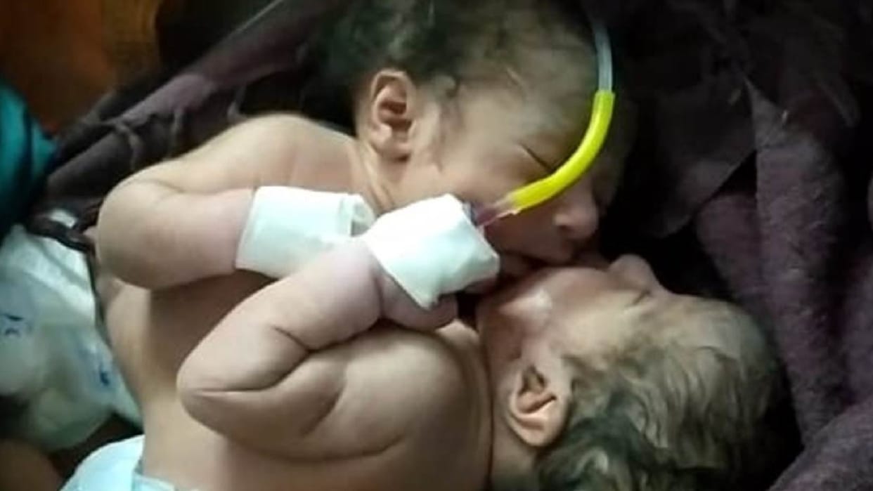 Birth of twin girls attached to chest and abdomen in Barwani stabilized and sent to Indore for treatment