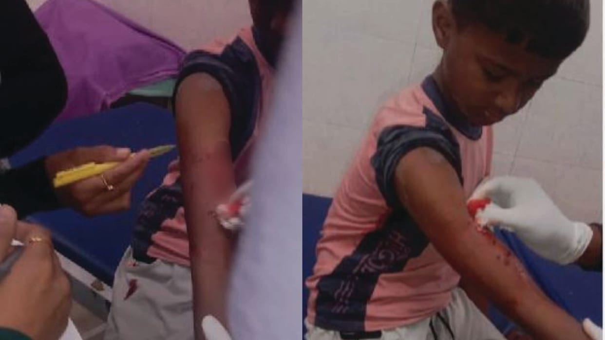 Pitbull dog bites child in Karnal, family members kill dog