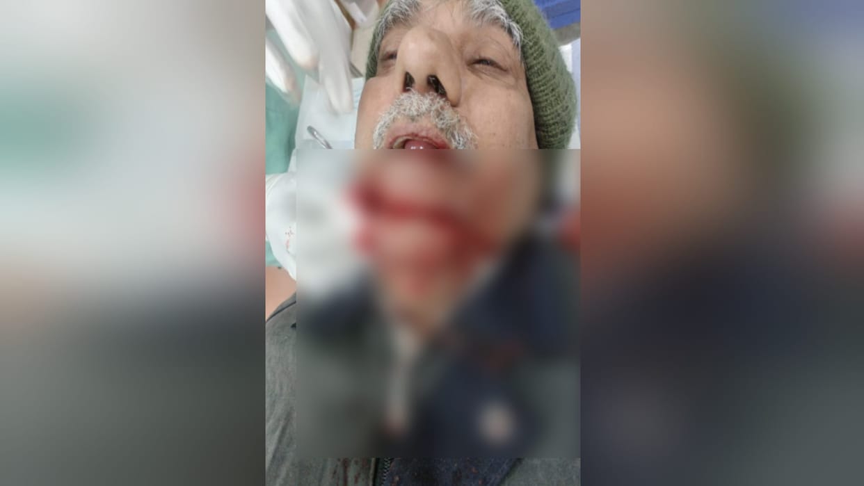 Meerut: an elderly man mouth was cut off by Chinese manjha in Shastri Nagar and 25 stitches were required