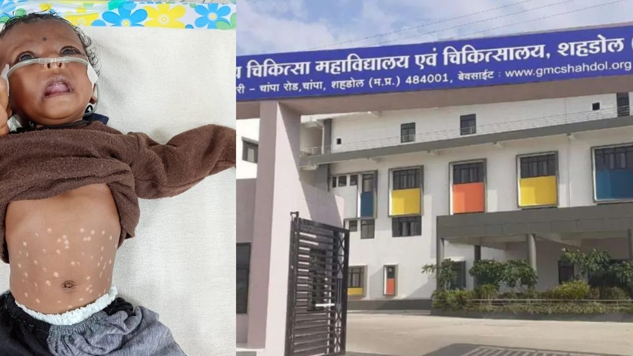 A three-month-old girl suffering from shortness of breath was burnt with hot rods 51 times in shahdol