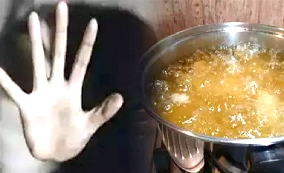 Husband pours boiling oil on his wife in Hamirpur, badly burnt her face