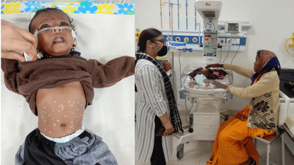 अंधविश्वास ने ली दुधमुंही की जान, शहडोल में इलाज के नाम पर 51 बार गर्म सलाखों से दागी गई बच्ची की मौत फाइल फोटो
