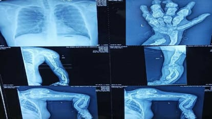 Interview Inspiring Journey Of 27 Years Old Cancer Survivor, know about bone cancer and ollier's disease