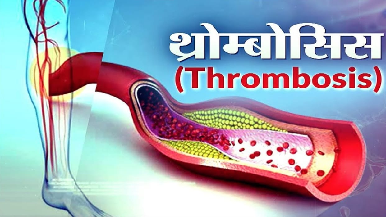 Patients will be able to get thrombolysis done in government hospitals, know what is thrombolysis?