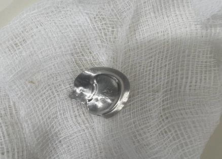 Lid stuck in woman's throat while drinking cold drink, could not breathe, doctors removed it without operation