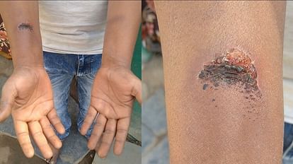 बच्चों के झगड़े में 'बाहरी' मुद्दा: पड़ोसी ने सिर फोड़ा तो शिकायत लेकर पहुंचा पिता, थानेदार ने उसी को पीट दिया युवक के शरीर पर पड़े चोट के निशान।
