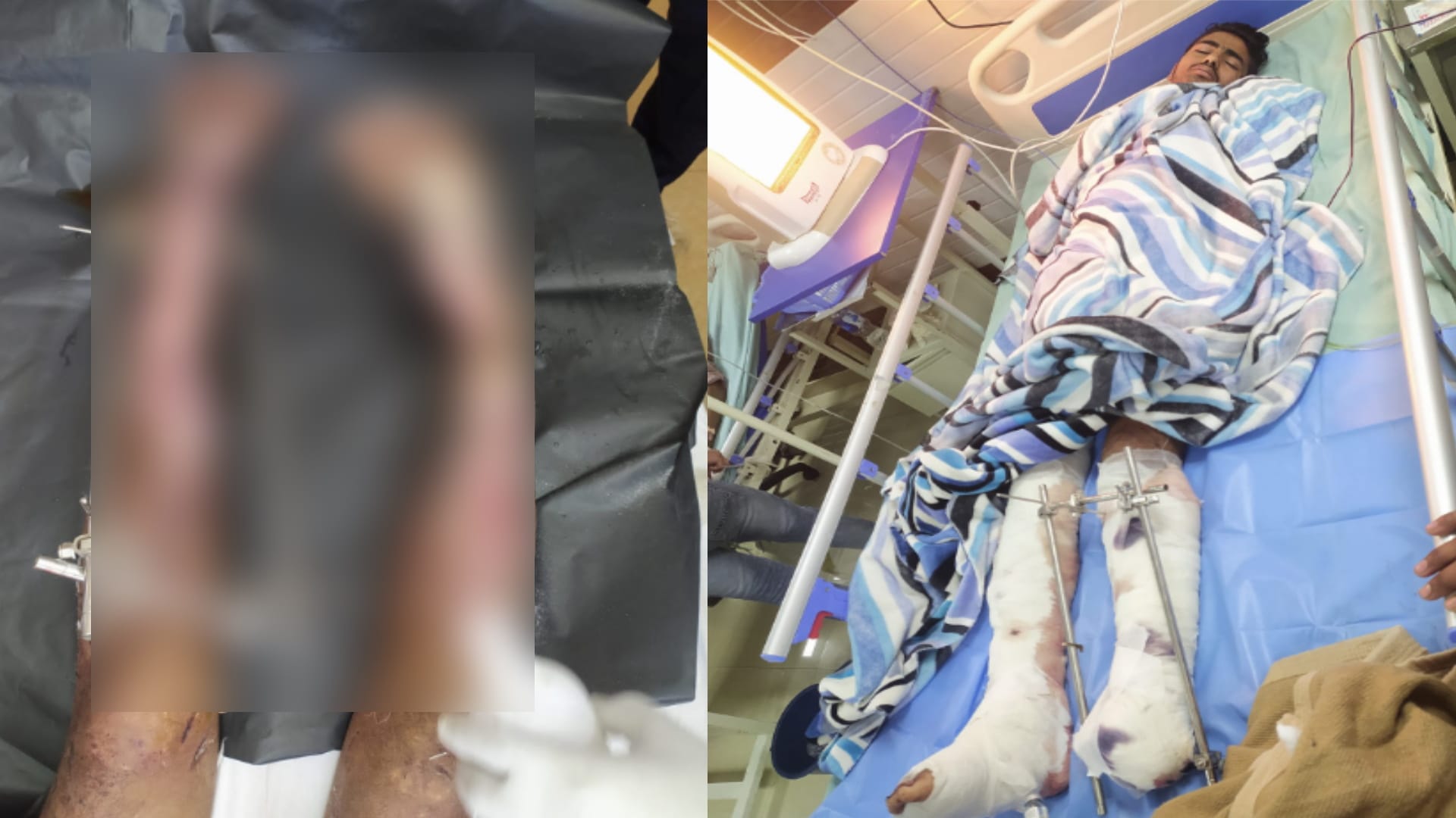 Fathers sad story only son also got his leg amputated, helplesss to get his treatment