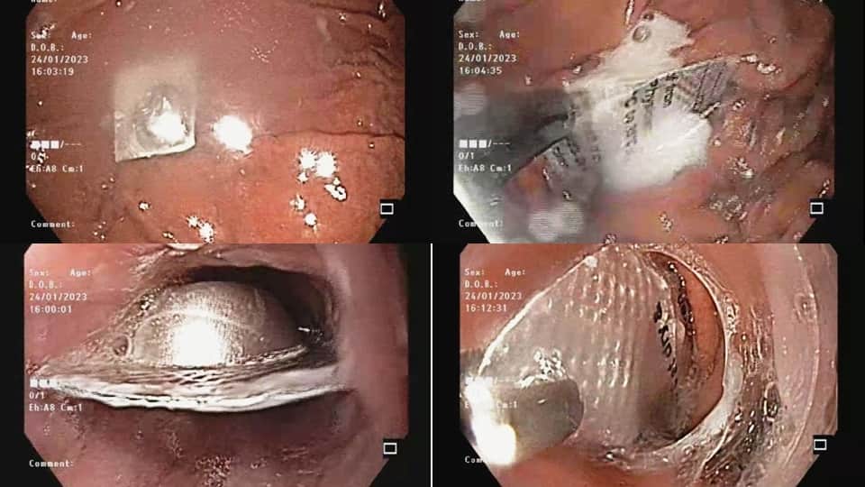 Medicine aluminum blister foil removed from patient food pipe without surgery in sir ganga ram hospital