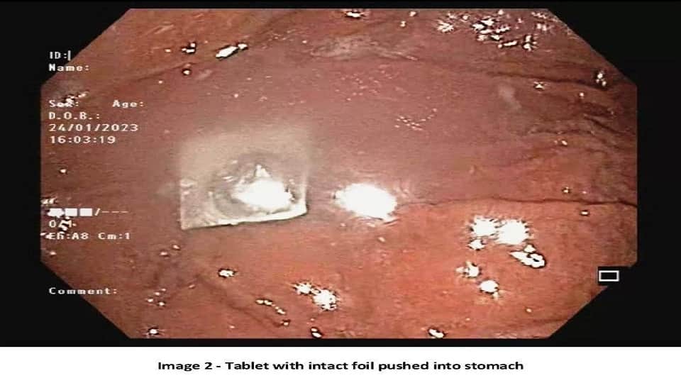 Medicine aluminum blister foil removed from patient food pipe without surgery in sir ganga ram hospital