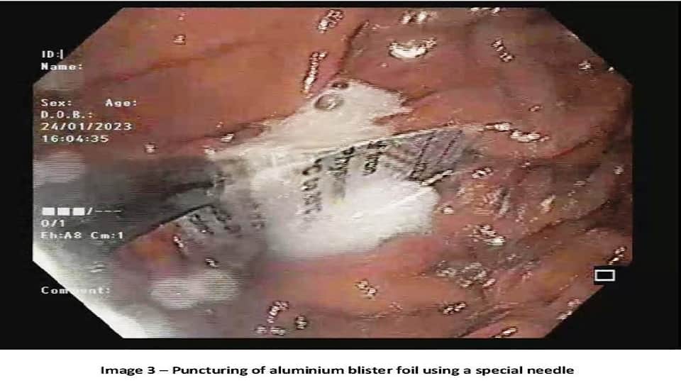 Medicine aluminum blister foil removed from patient food pipe without surgery in sir ganga ram hospital