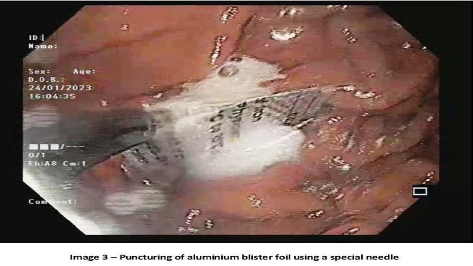 Medicine aluminum blister foil removed from patient food pipe without surgery in sir ganga ram hospital