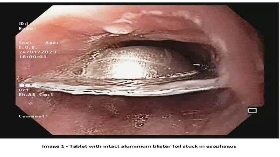 Medicine aluminum blister foil removed from patient food pipe without surgery in sir ganga ram hospital