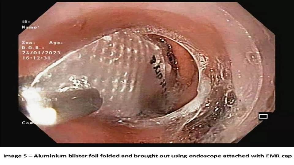 Medicine aluminum blister foil removed from patient food pipe without surgery in sir ganga ram hospital