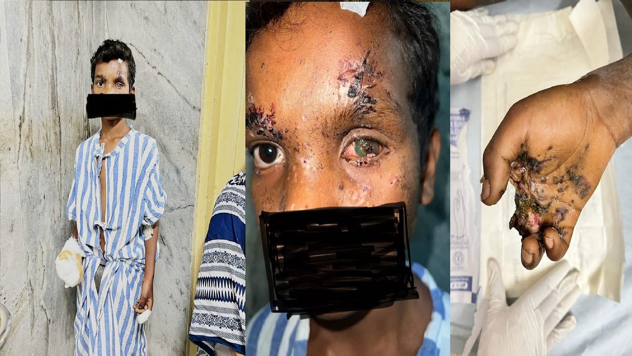 11 year old child injured by mobile blast