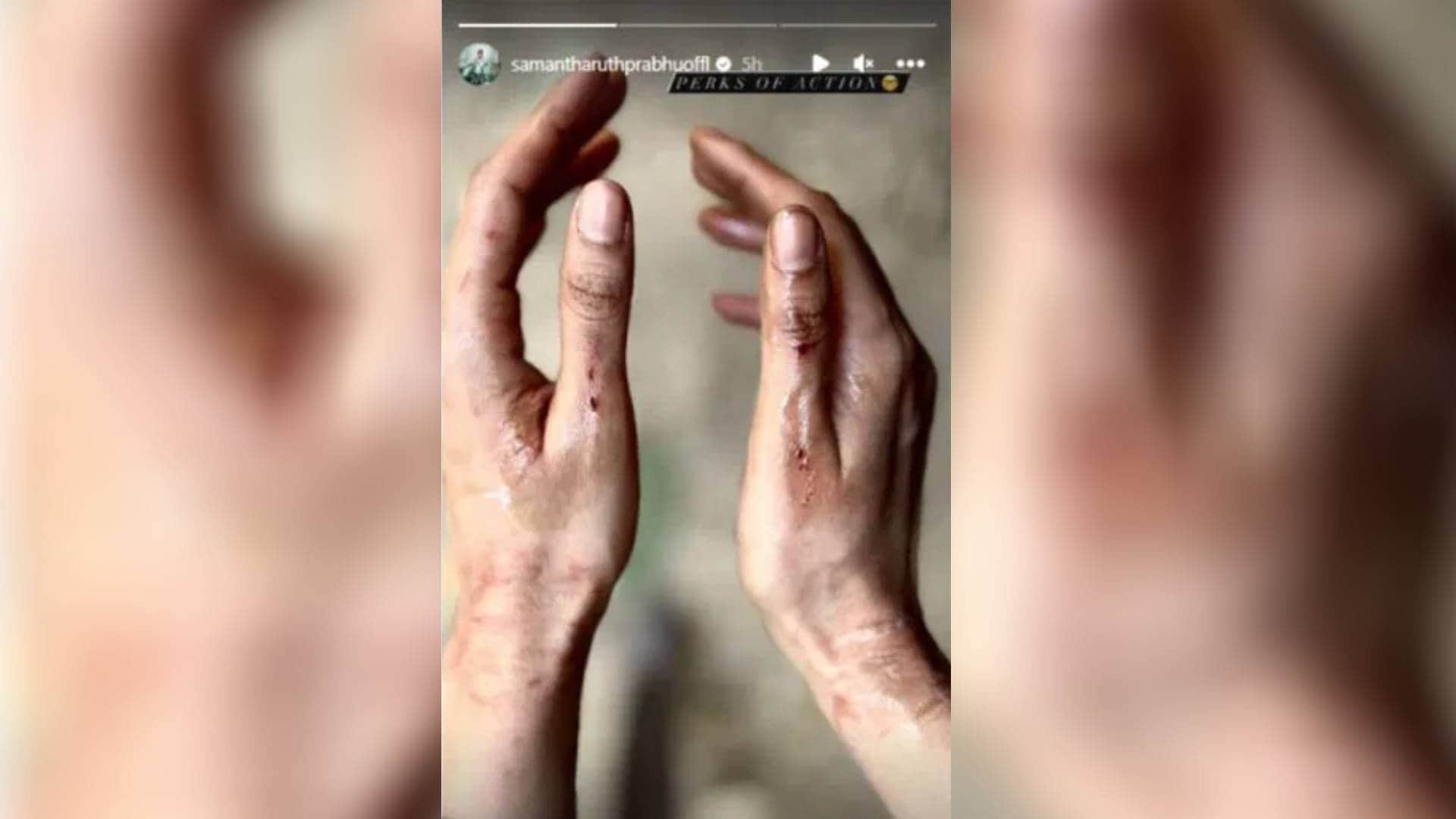 Samantha Ruth Prabhu injured while doing an action scene shooting on Citadel set shares pics on instagram