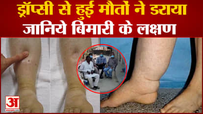 Death of three people due to dropsy caused stir, know what is the cause and symptoms of the disease