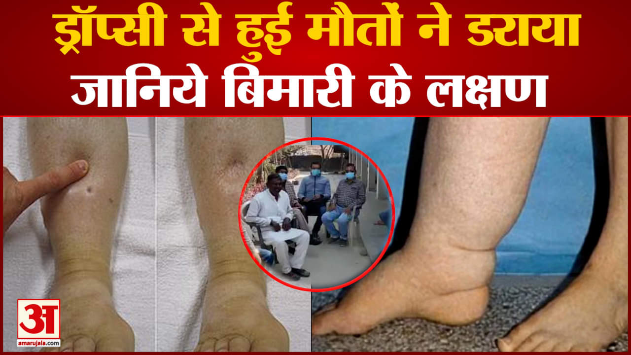 ड्रॉप्सी