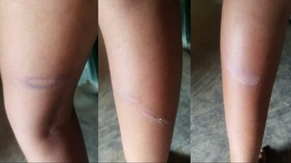 पिटाई से बच्चों के पैरों पर पड़े निशान।