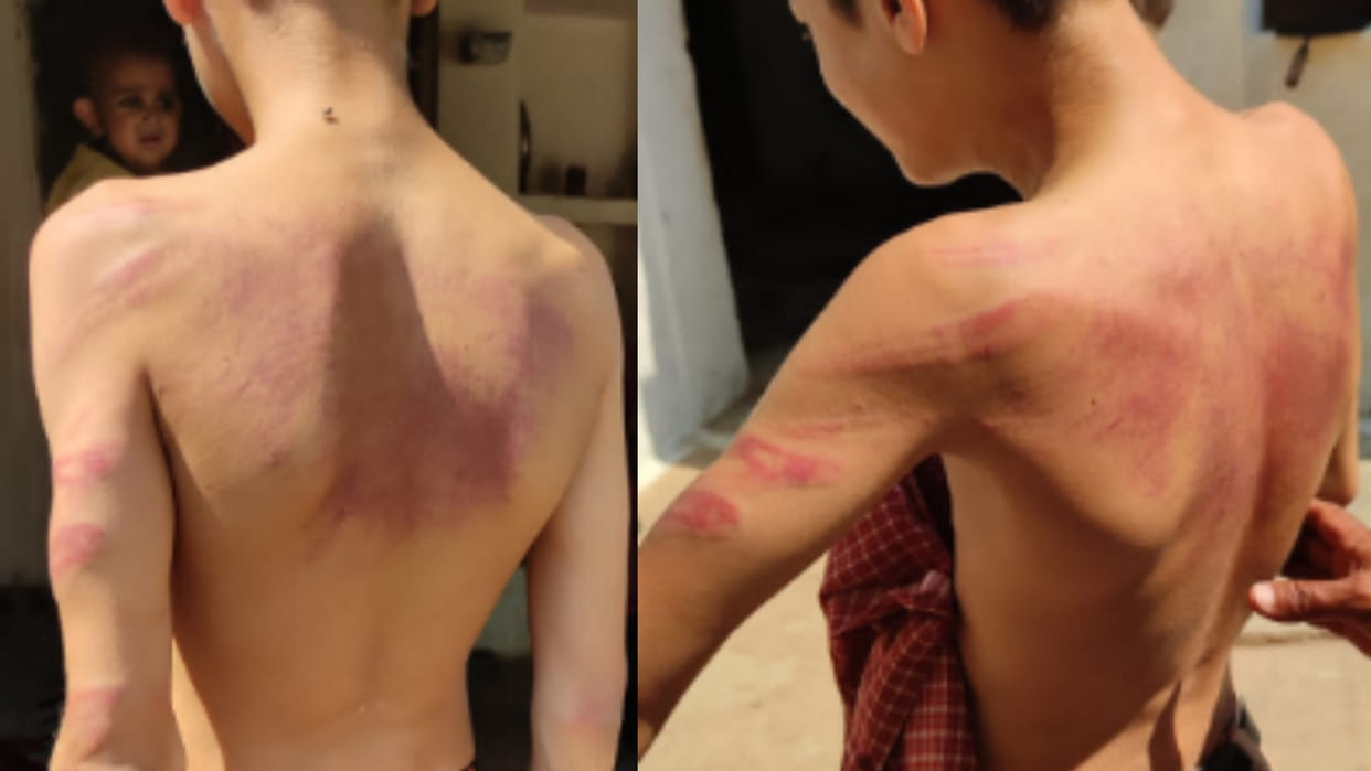 Teacher became a monster in Bhind, class-6 student was mercilessly beaten up by his teacher