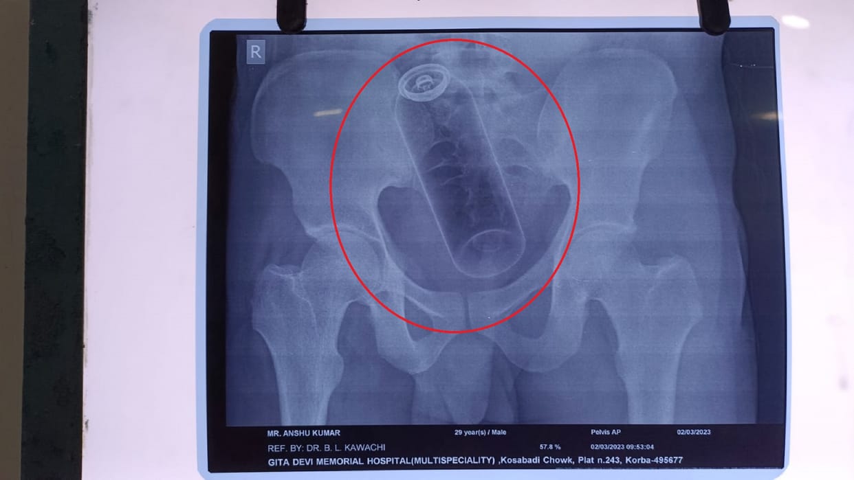 young man put a bottle of Deo in the stomach from the anus doctors took it out