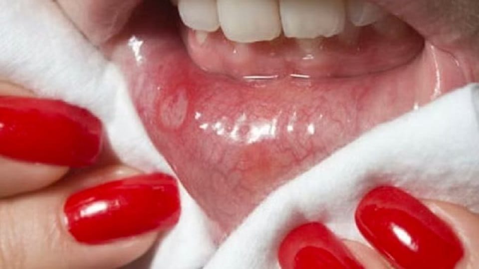 hiv and aids prevention, early signs and symptoms of hiv in hindi