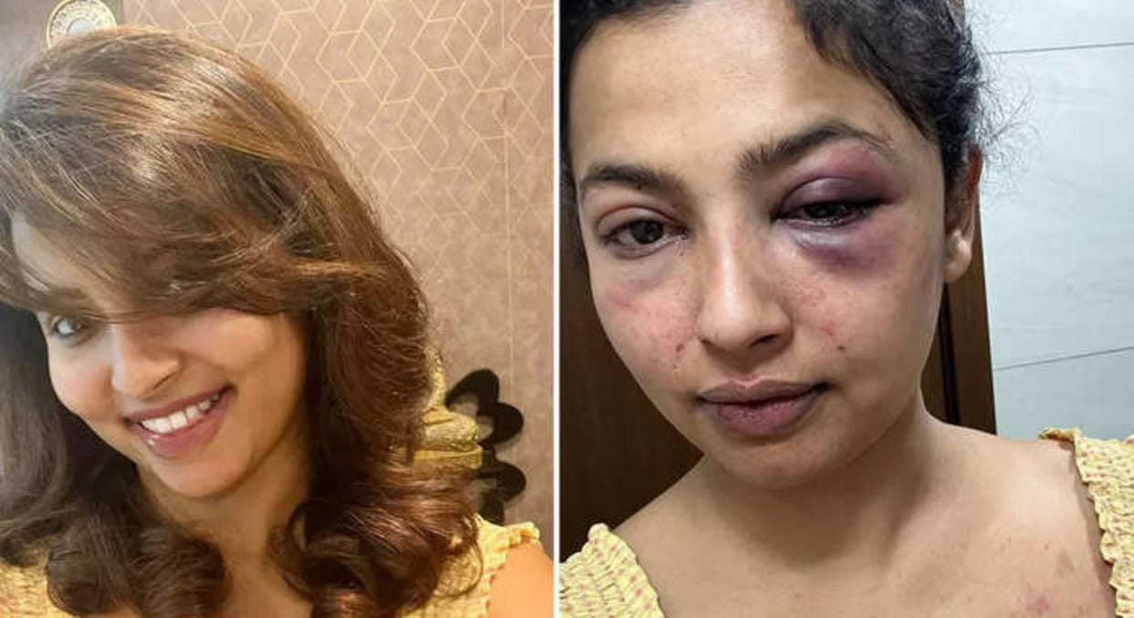 South actress Anicka Vijayi Vikramman brutally beaten by her ex boyfriend shares pics of bruises