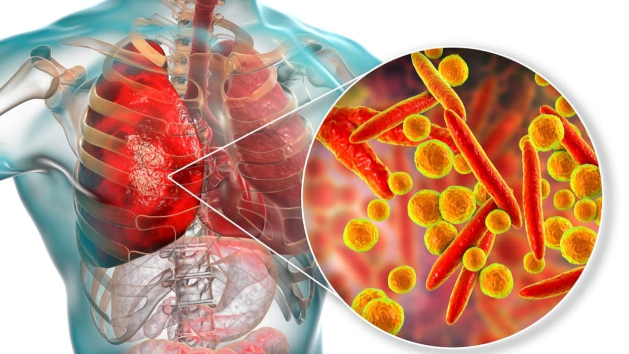 Childhood pneumonia linked with higher death risk from respiratory infection as adult: Lancet study