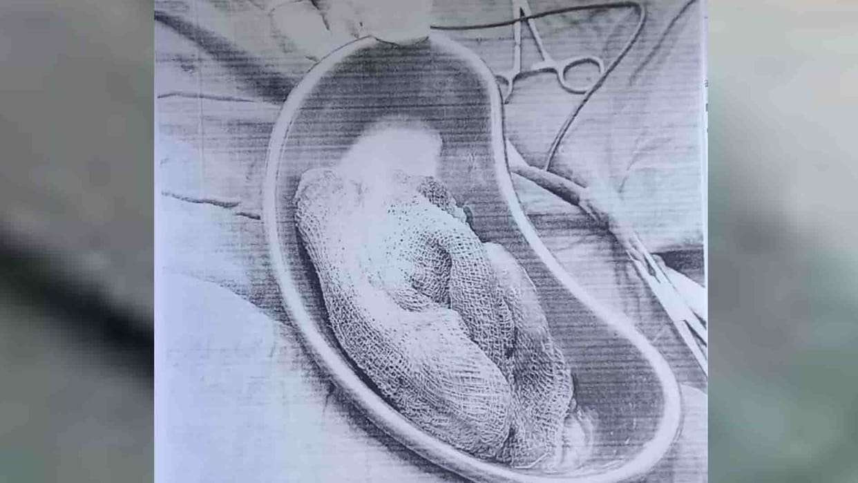 Kanpur: Negligence during delivery in CHC, strip left in abdomen during pregnant operation