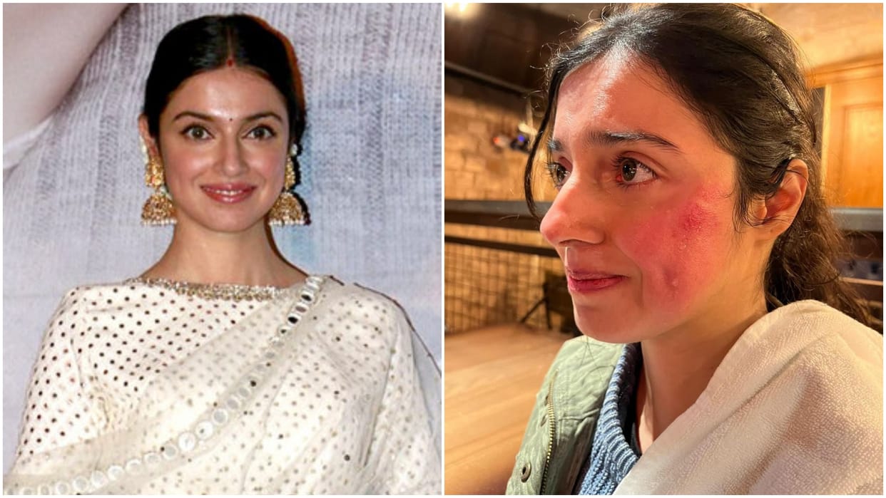 Divya Khosla Kumar face injured during yaariyan 2 action scene shooting in uk shared pictures