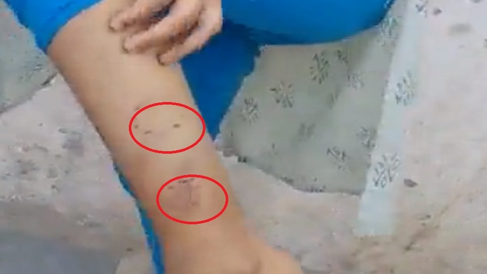 Dowry greedy people beat Iqra scratched her body with teeth at many places