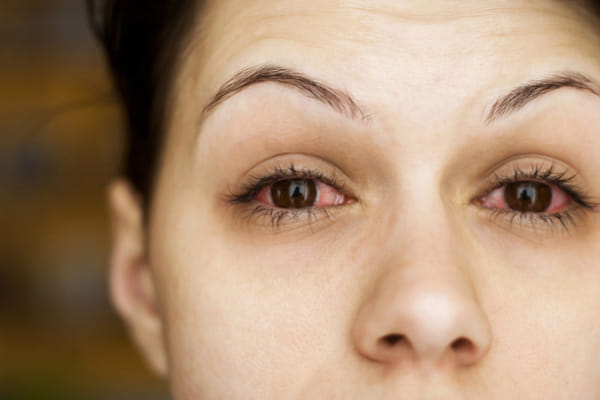 Rapidly increasing risk of conjunctivitis eye flu these are the symptoms and methods of prevention