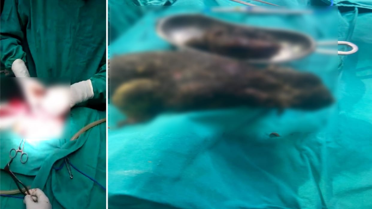 Bijnor: the doctor took out two kg hair bundles from the stomach of a teenager by performing an operation