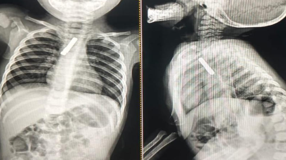 Doctors of SN Medical College in Agra successfully operated pin stuck in trachea of nine month old child