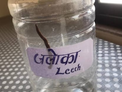 Leech Therapy: Treatment with leech therapy will be done at Jalouka Center in BHU, know how it is treated?