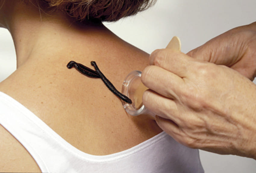 Leech Therapy: Treatment with leech therapy will be done at Jalouka Center in BHU, know how it is treated?