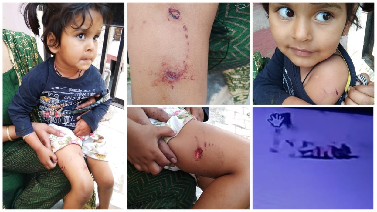 A four-year-old girl was bitten by a pitbull breed dog in Ambala
