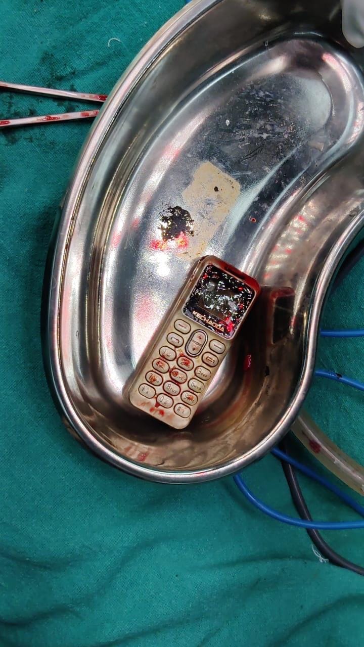 After a fight with brother in Bhind, sister swallowed mobile in anger, doctors removed it after surgery