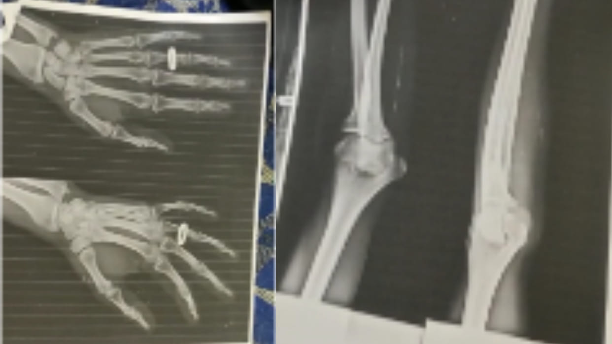 X-ray print is being given on paper to patients in Union Minister's hometown