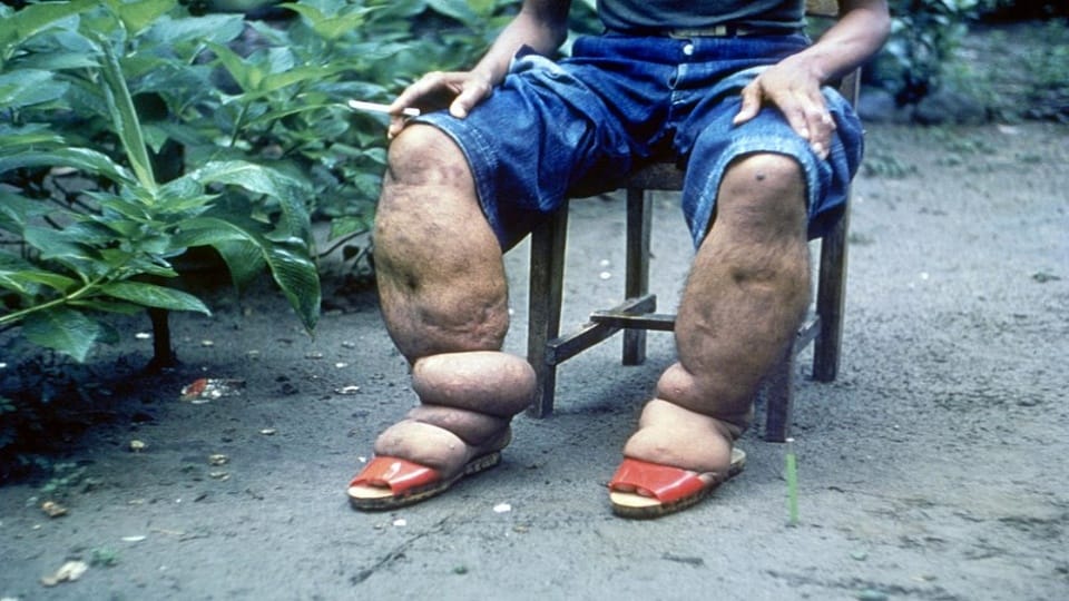 ELISA kit ready to eliminate filariasis disease