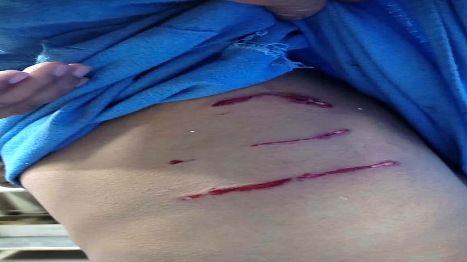 AMU Researcher attacked by a pack of dogs